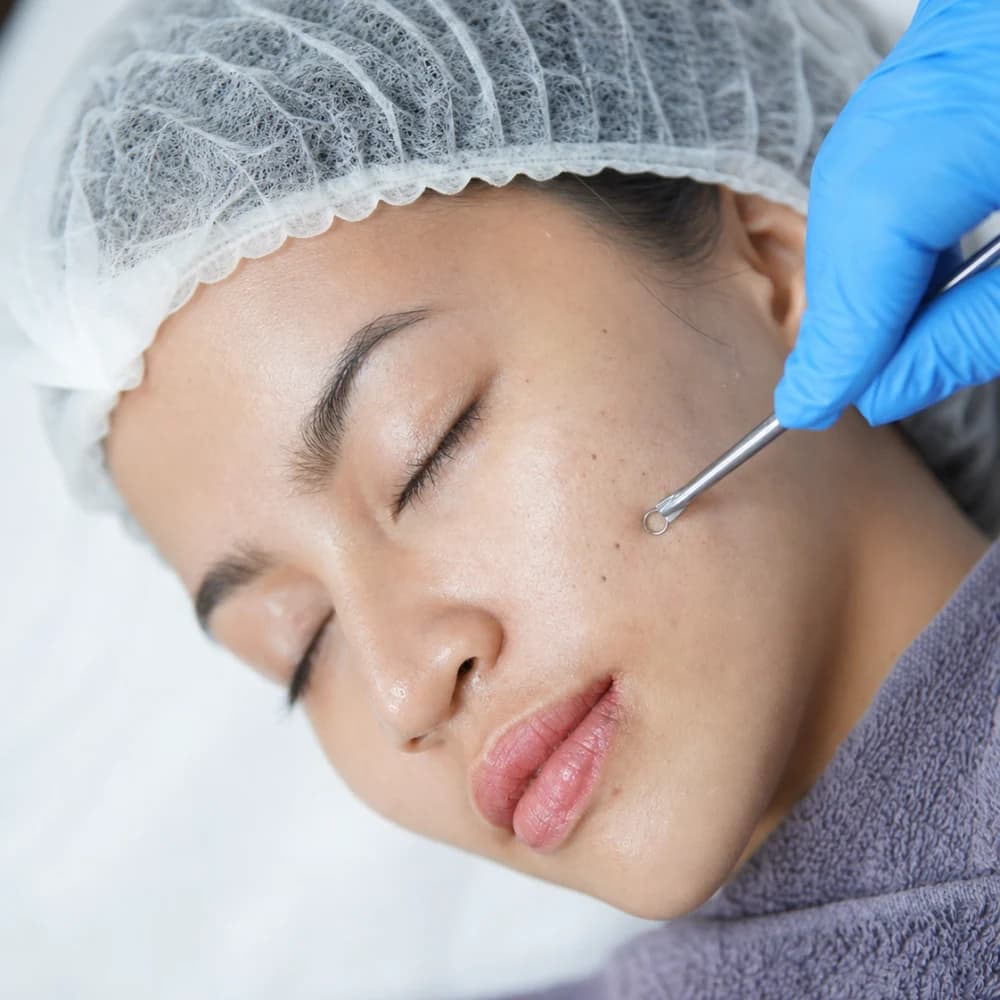 Acne Facial di MALVÉ Beauty Clinic