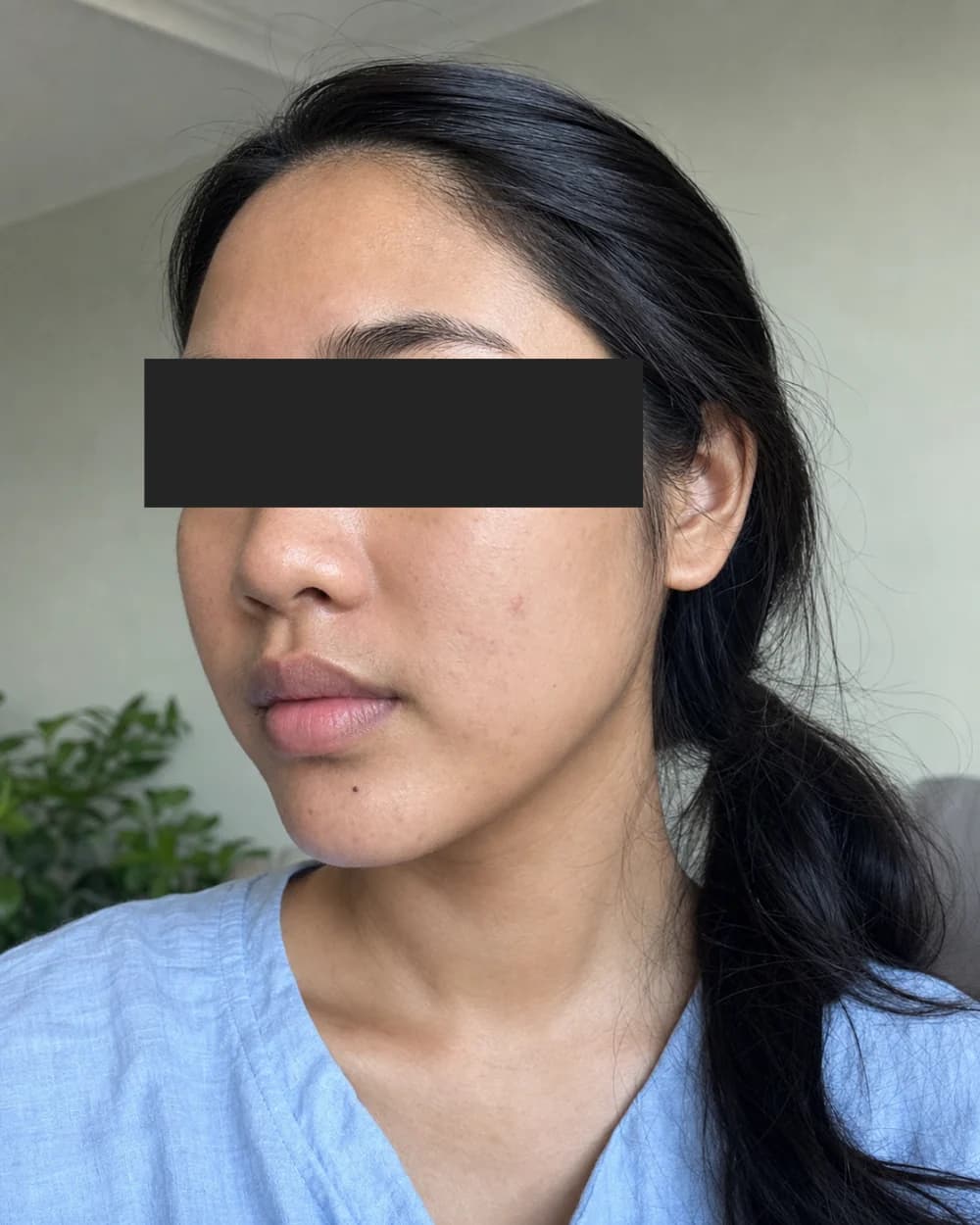 Kulit setelah Acne Facial