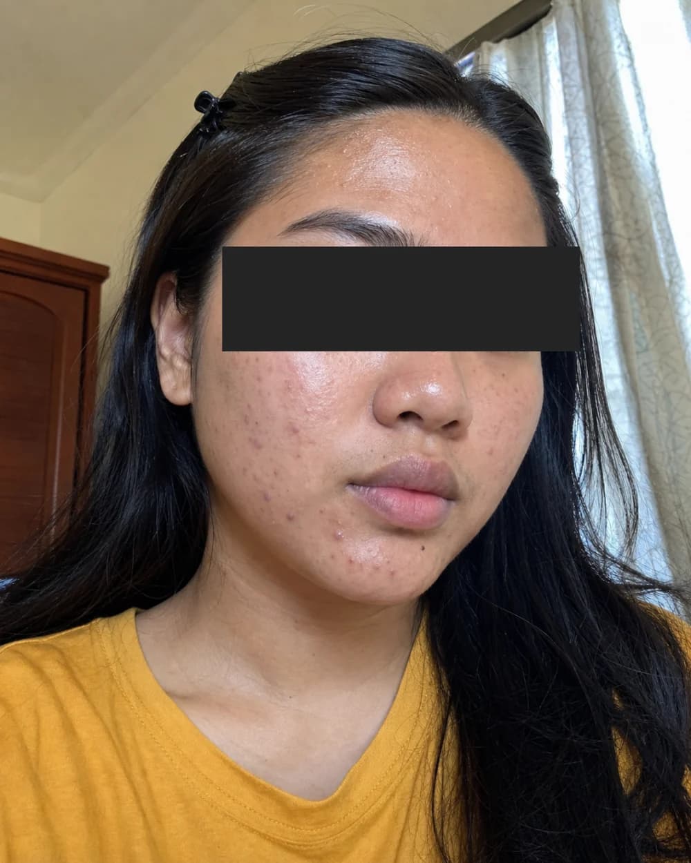 Kulit berjerawat sebelum Acne Facial