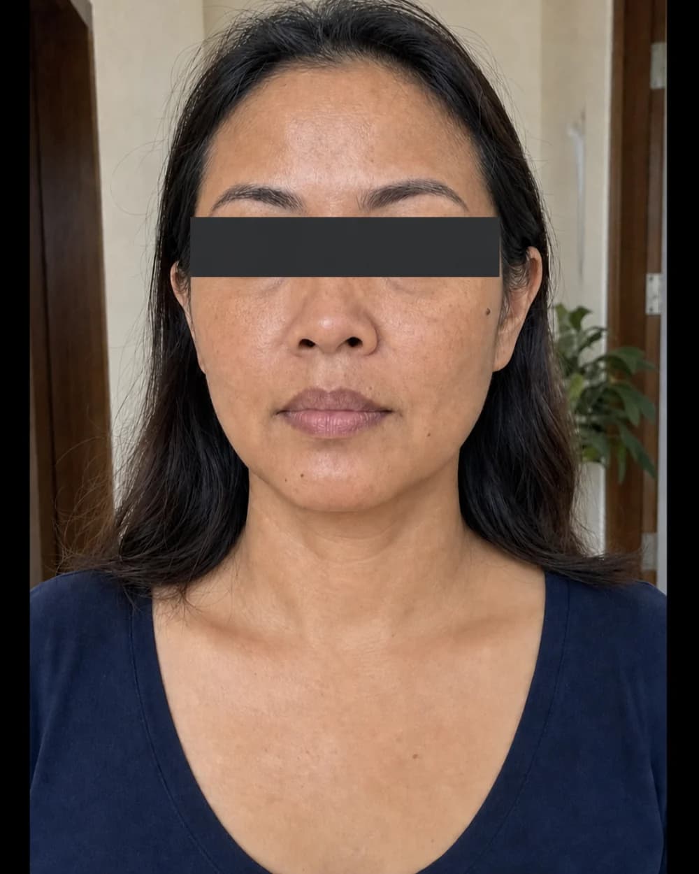 Kontur wajah setelah HIFU Face