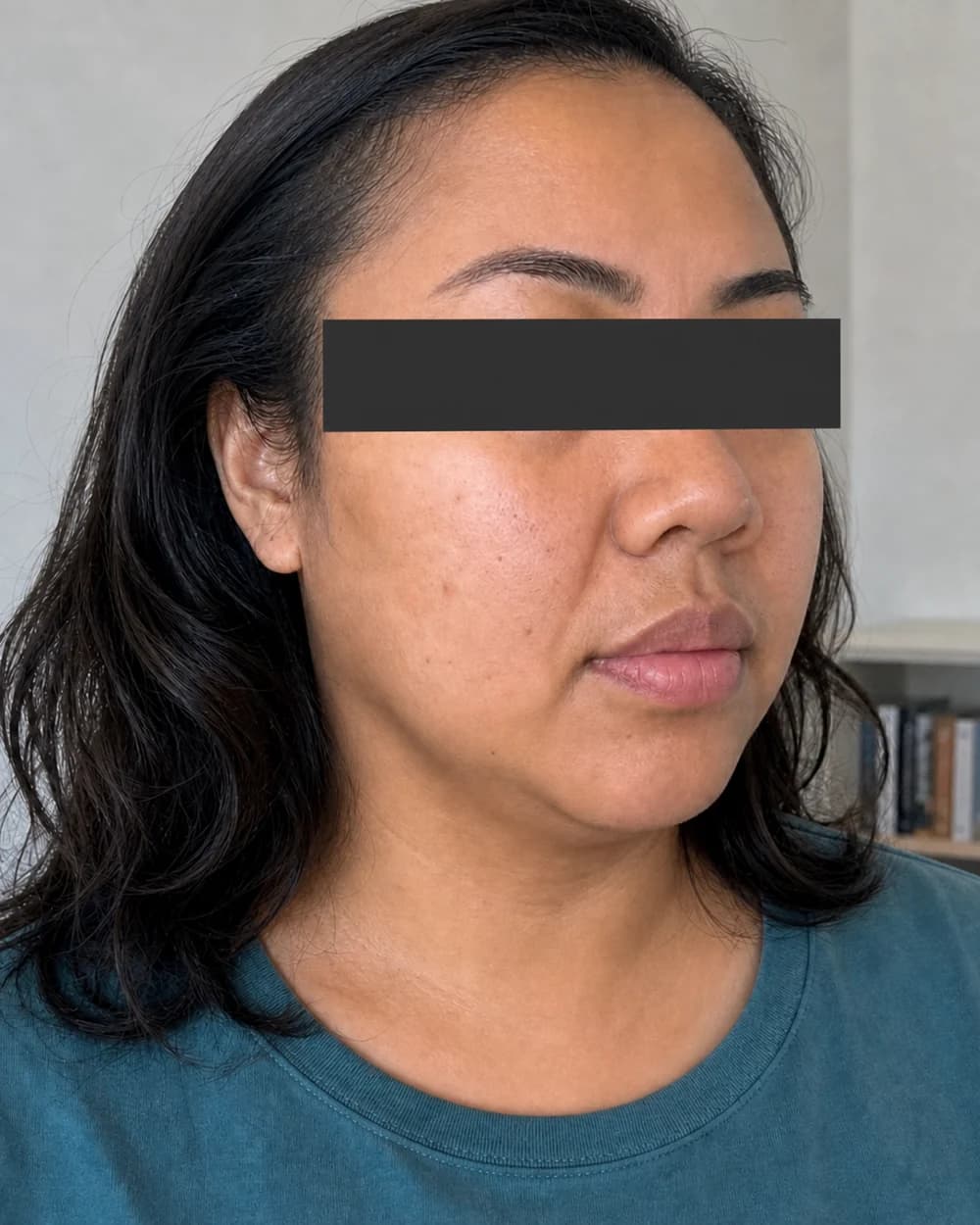 Kontur bawah dagu setelah Mesolipo Double Chin