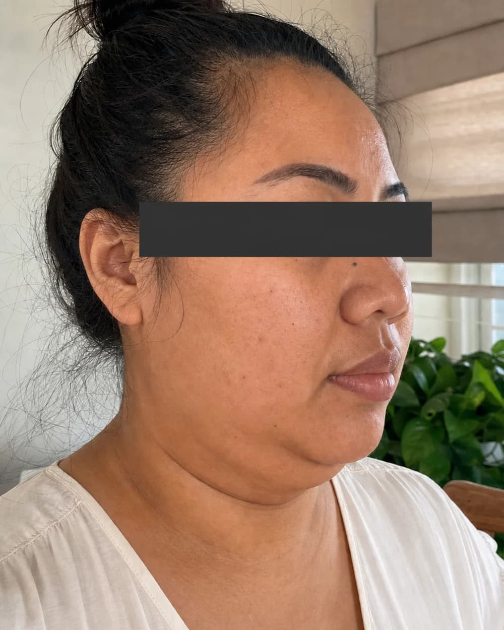 Kontur bawah dagu sebelum Mesolipo Double Chin
