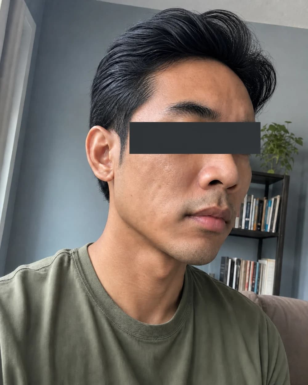 Acne scar setelah treatment subsisi