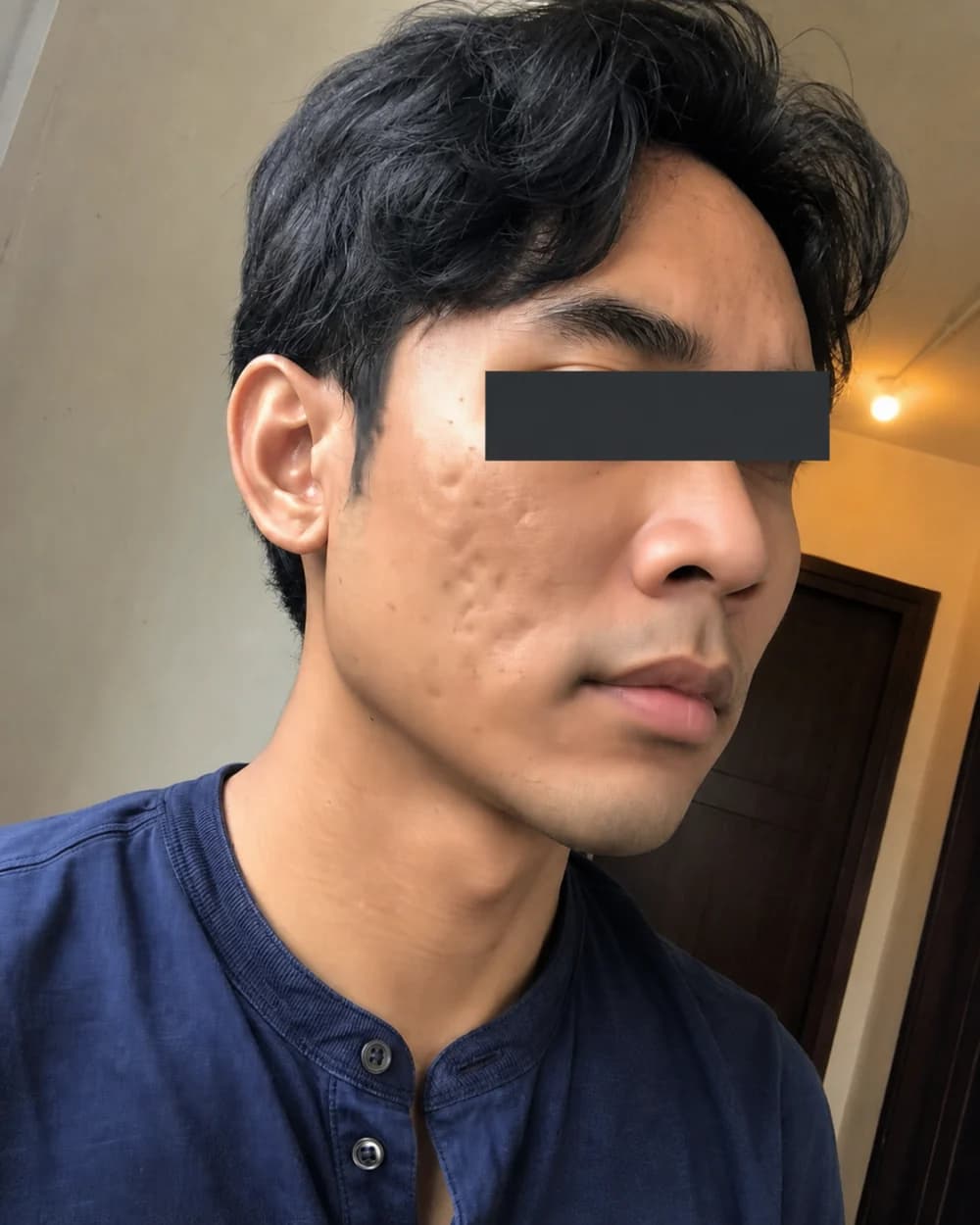 Acne scar sebelum treatment subsisi